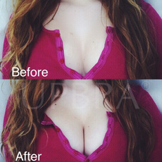Upbra before and after
